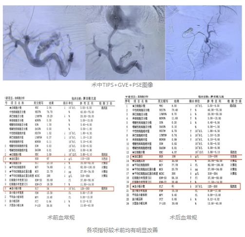 哈医大四院介入血管外科应用TIPS技术:-哈尔滨医科大学附属第四医院官网